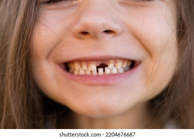 Close-up A Cute Funny Girl Without A Baby Tooth. A Toothless Smile. A Milk Tooth Fell Out. Selective Focus. High Quality Photo