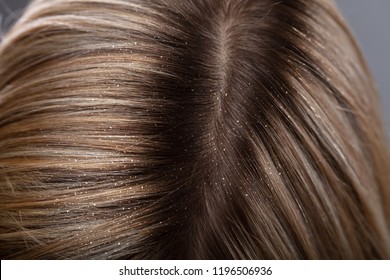 Itchy Hair Head Images Stock Photos Vectors Shutterstock