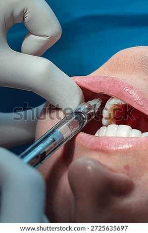 Close-up of dental injection procedure using local anesthesia. Dentist performs pain control before treatment in a modern clinic. Oral care, dentistry, healthcare concept.