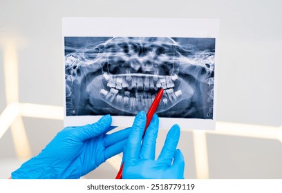 Close-up of dental X-ray in clinic. A dental professional in gloves reviews an X-ray of teeth, focusing on specific areas with a red pointer in a modern clinic. - Powered by Shutterstock