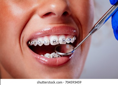 Close-up of a dentist checking braces with a dental mirror on the female patient. 