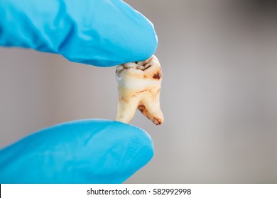 Close-up Of Dentist Hand In Glove Holding Decay Tooth