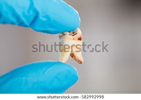 Close-up Of Dentist Hand In Glove Holding Decay Tooth