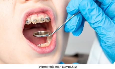 Closeup Of Dentist Using An Instrument To Visualize The Teeth Of A Child Patient