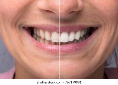 Close-up Detail Of Person Teeth Showing Before And After Whitening