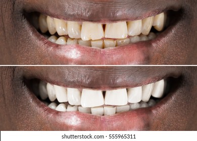 Close-up Detail Of Smiling Man Teeth Before And After Whitening