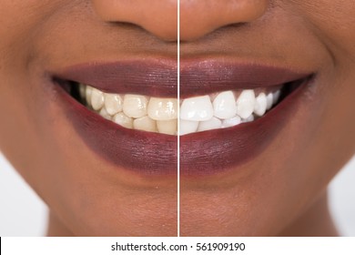 Close-up Detail Of Smiling Woman Teeth Before And After Whitening