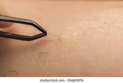 Close-up Detail Of Woman Using Pair Of Tweezers, Removing Hair From Hairy Leg. With Dry Skin Problem