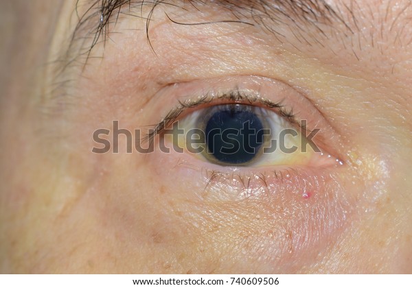 拡張した瞳の病気の目の接写 角膜黒目と白い虹彩の黄色の問題 気を付けないときは非常に危険な病気で 医者に診てもらう 限定フォーカス の写真素材 今すぐ編集