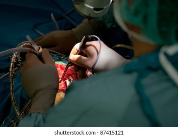 Close-up Of Doctor Performing Brain Surgery