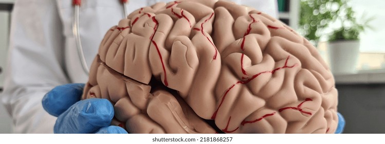 Closeup Of Doctorn Hand Holding Model Of The Human Brain. Chronic Cerebral Ischemia