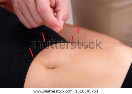 Close-up Of Doctor's Hand Perform Medical Professional Acupuncture Treatment In Beauty Spa On Woman's Body