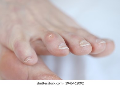 Closeup Of Dry Callus On Woman Toe