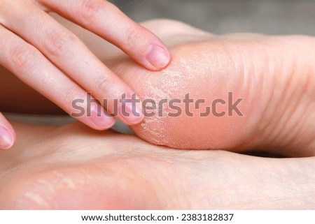 Close-up Dry skin on the heels of the feet