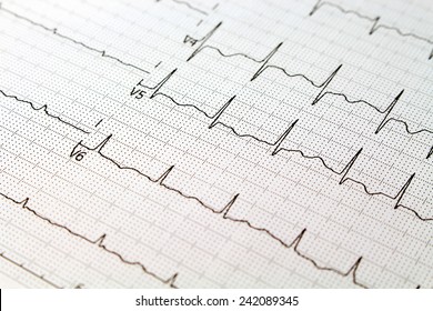 Closeup Of ECG Paper, Normal Sinus Rhythm