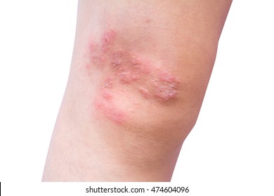 Close-up Eczema Atopic Dermatitis Symptom With Infected Skin On Child, Kid Knee With Clipping Path.Patient With Psoriasis.