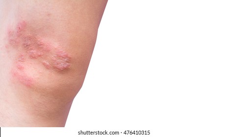 Close-up Eczema Atopic Dermatitis Symptom With Infected Skin On Child Leg, Kid Knee With Copy Space. Wound From Insect Bite Or Fungus Or Bacteria Or Virus.