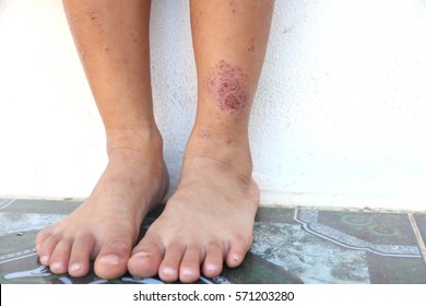 Close-up Eczema Atopic Dermatitis Symptom With Infected Skin On Child, Kid  Legs