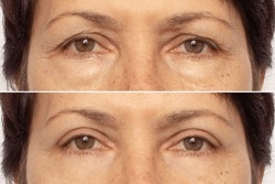 Close-up Of An Elderly Woman's Eyes Before And After Blepharoplasty. Rejuvenation Procedure, Correction Of The Upper And Lower Eyelids. Removing Wrinkles, Puffiness And Bags Under The Eyes. Beauty