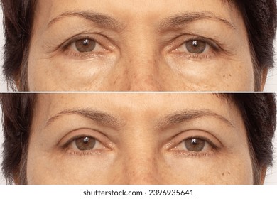 Close-up of an elderly woman's eyes before and after blepharoplasty. Rejuvenation procedure, correction of the upper and lower eyelids. Removing wrinkles, puffiness and bags under the eyes. Beauty