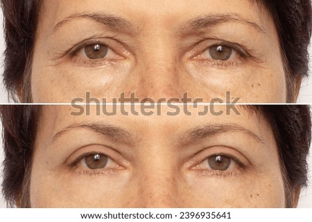 Close-up of an elderly woman's eyes before and after blepharoplasty. Rejuvenation procedure, correction of the upper and lower eyelids. Removing wrinkles, puffiness and bags under the eyes. Beauty