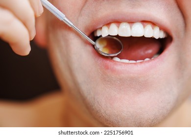 close-up. examination of teeth with veneers with a special dental mirror. the concept of dental and oral hygiene. - Shutterstock ID 2251756901