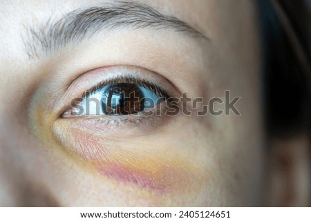 Close-up eye bruise hematoma of young woman suffered from domestic violence. Part of female victim injured face. Abuse, tyranny, human cruelty intimidation, physical violence, aggression concept.