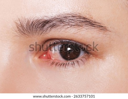 Close-up of an eye with conjunctivitis