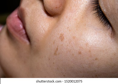 Close-up face women show the freckles, black spots, cheek groove, pimple and uneven skin tone. - Shutterstock ID 1520012075