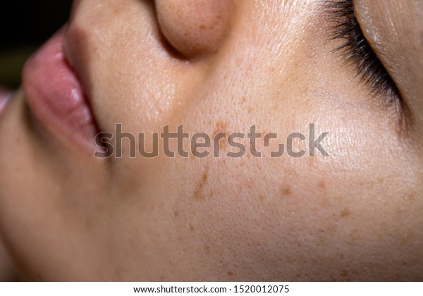 Close-up face women show the freckles,\
black spots, cheek groove, pimple and uneven skin\
tone.