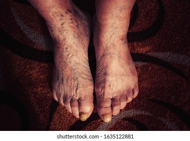 Close-up Feet Of Big Old Woman's Nails