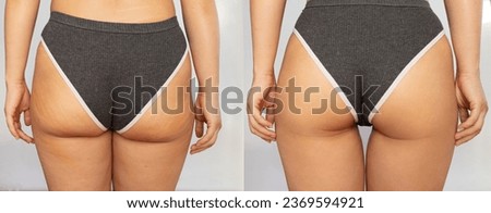 Close-up of female buttocks with cellulite before and after treatment isolated on a white background. Getting rid of excess weight, diet, healthy nutrition, training, sports, massage, scrub. Wellness