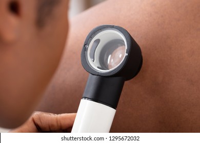 Close-up Of A Female Doctor Checking Pigment Skin On Man's Back With Dermatoscope