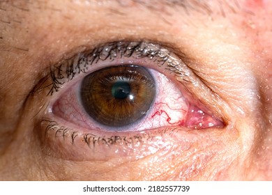 Close-up Of A Female Eye With Red Inflamed And Dilated Capillaries. Blood Vessel. The Vessel Burst.