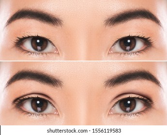 double eyelid operation