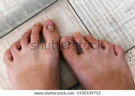 close-up of a female foot. The nails are damaged by disease. grow back. damaged skin and thumbnail