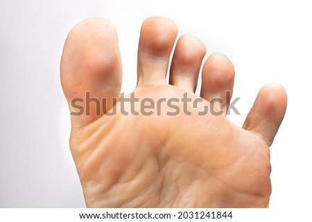 Closeup of a female foot with toes apart to inspect athlete's foot, isolated on white background. Concept of hygiene, fungal infections and onychomycosis