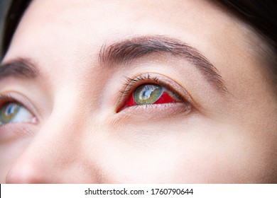Closeup of female green eye stained with red blood. Сonsequences of surgery, intravitreal administration of medicinal product. Treatment of macular degeneration. Violence concept. Vision diseases.
