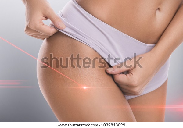Close-up of female hips with a stretch marks\
during laser removal session\
treatment