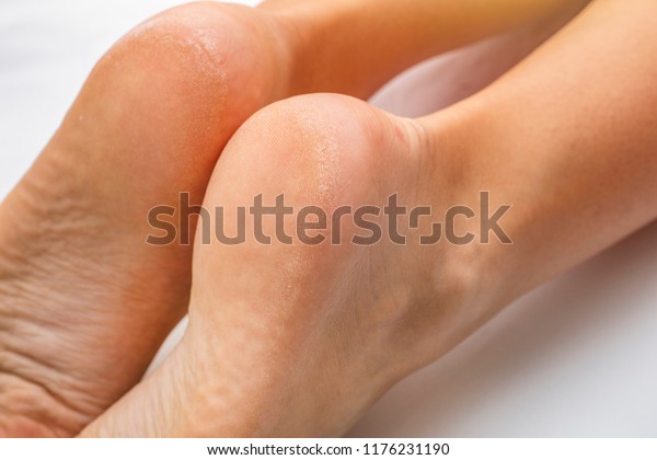 sore dry feet