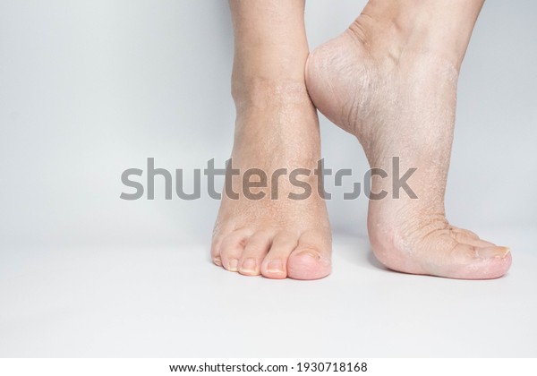 Close-up female sore skin of feet, dry heels\
isolated on a white\
background