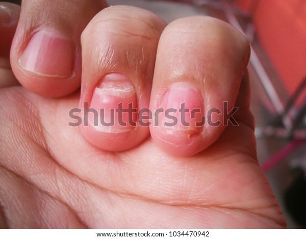 Dyshidrotic Eczema Nails