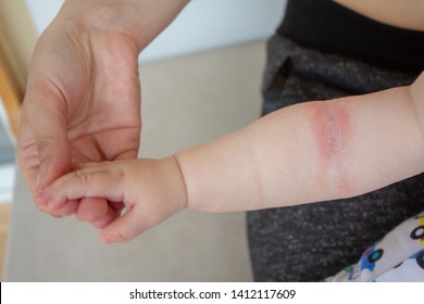 Close-up Of The Folds Of The Hand Of A Newborn Baby With Red Skin. Atopic Dermatitis Of Children's Skin. Prickly Heat. Diaper Rash.