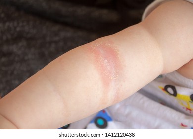 Close-up Of The Folds Of The Hand Of A Newborn Baby With Red Skin. Atopic Dermatitis Of Children's Skin. Prickly Heat. Diaper Rash.