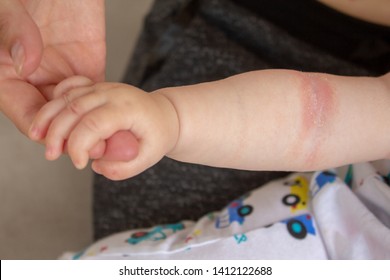 Close-up Of The Folds Of The Hand Of A Newborn Baby With Red Skin. Atopic Dermatitis Of Children's Skin. Prickly Heat. Diaper Rash.