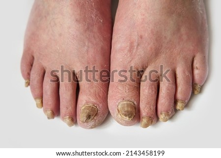 Closeup of a foot with damaged nails because of fungus. Elderly man legs. Diabetis