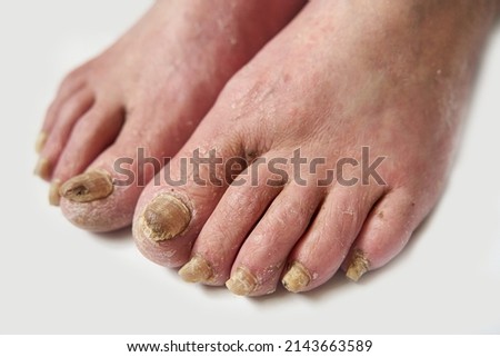 Closeup of a foot with damaged nails because of fungus. Elderly man legs.