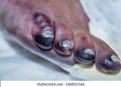 Closeup Of Foot With Gangrene