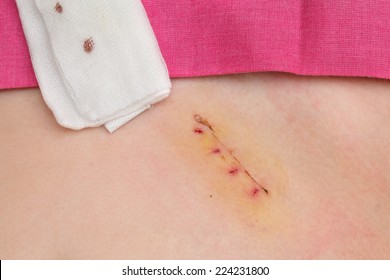 Closeup Fresh Appendix Surgery Scar Appendectomy : photo de stock ...