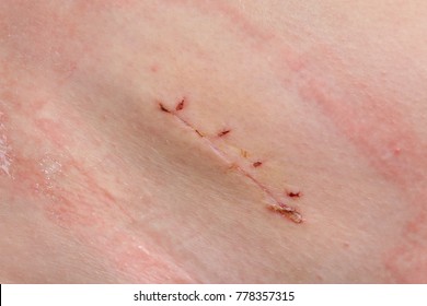 Closeup Of Fresh Appendix Surgery Scar, Appendectomy